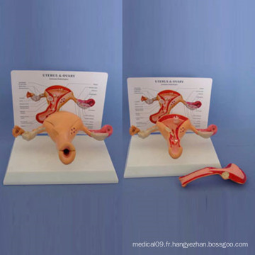 Modèle d&#39;anatomie de l&#39;utérus morbide mâle pour l&#39;enseignement médical (R110201)